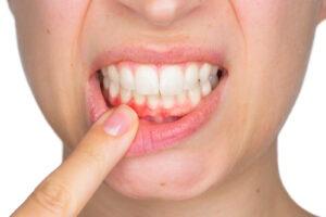 Gum Recession: Causes & Treatments