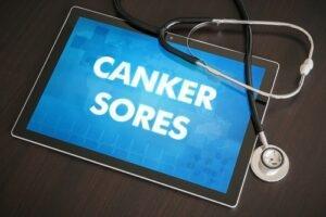 Canker Sore Treatment