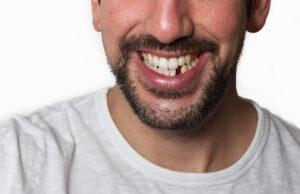The Honest Truth About Your Missing Tooth