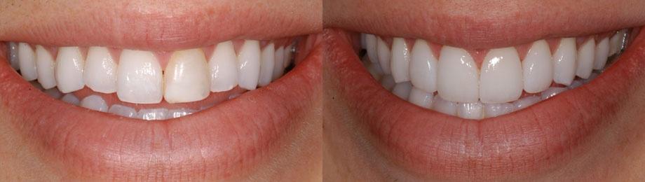 Before and After dental procedures