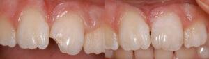 Before and After dental procedures