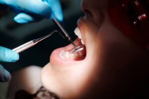 Regular And Deep Dental Cleaning
