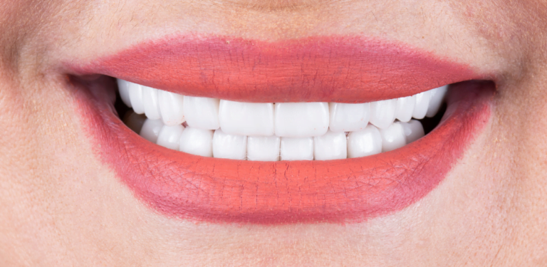 Smile Confidently With Dental Veneers