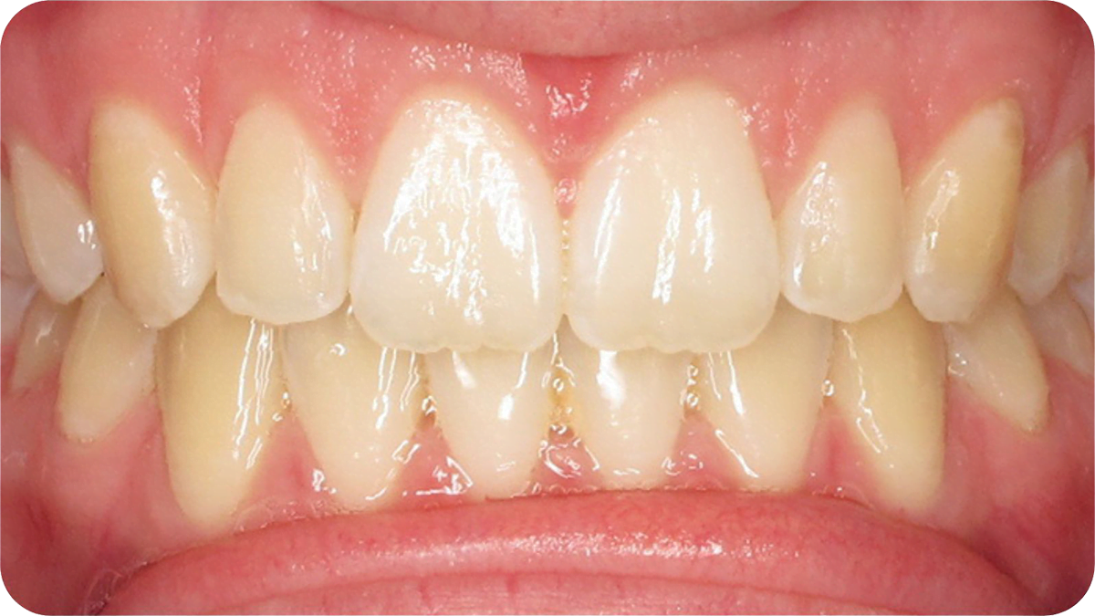 teeth after clear dental aligners