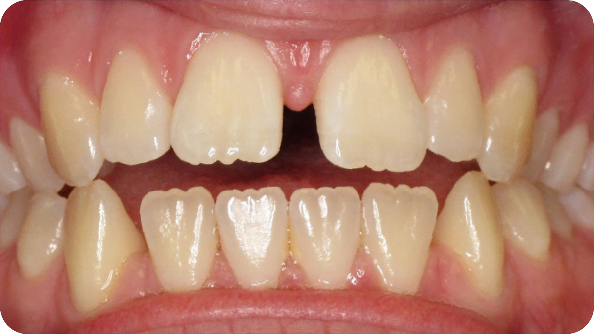 teeth before clear dental aligners