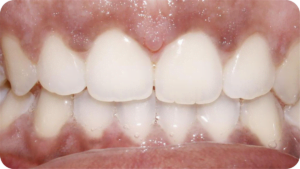 Teeth After Invisalign®