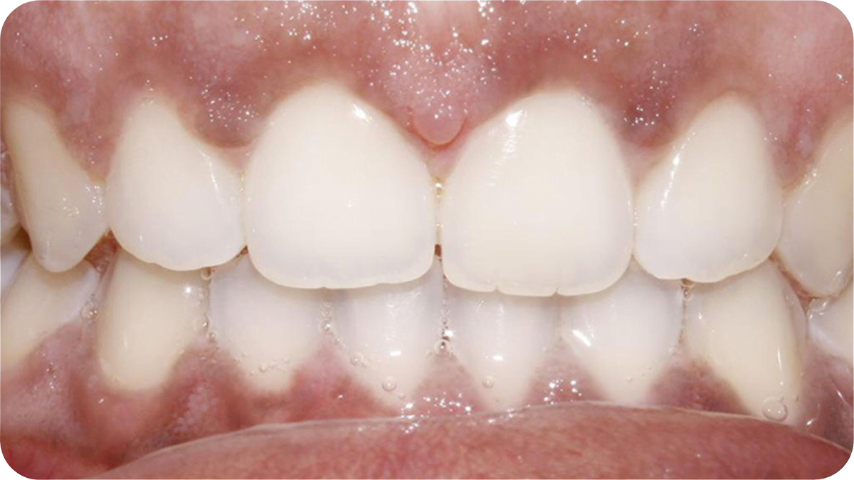 Teeth After Invisalign®