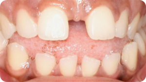 Teeth Before Invisalign®