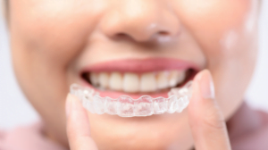 Is Invisible Braces the Right Choice for You? - J Street Dental Group