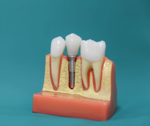 a model of teeth with implants